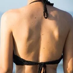 Body Moles & Freckles